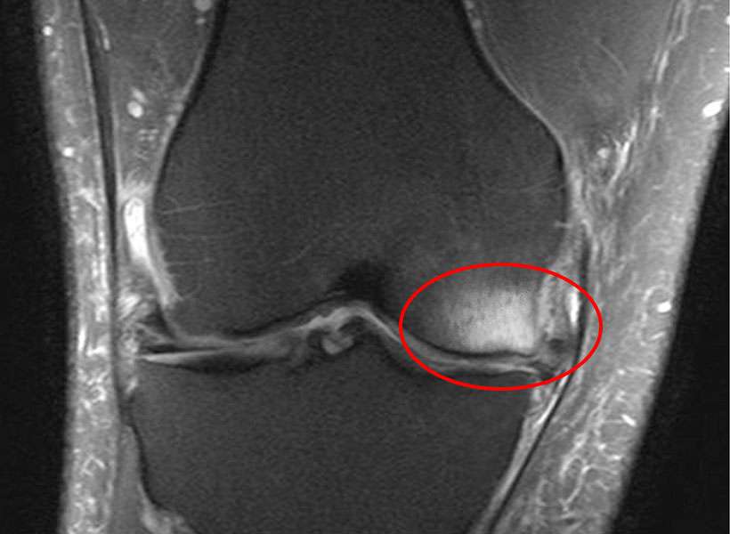 bone marrow lesion treatment miami
