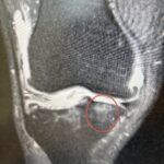 bone marrow lesions knee pain in Miami — Dr. William Bonner Miami
