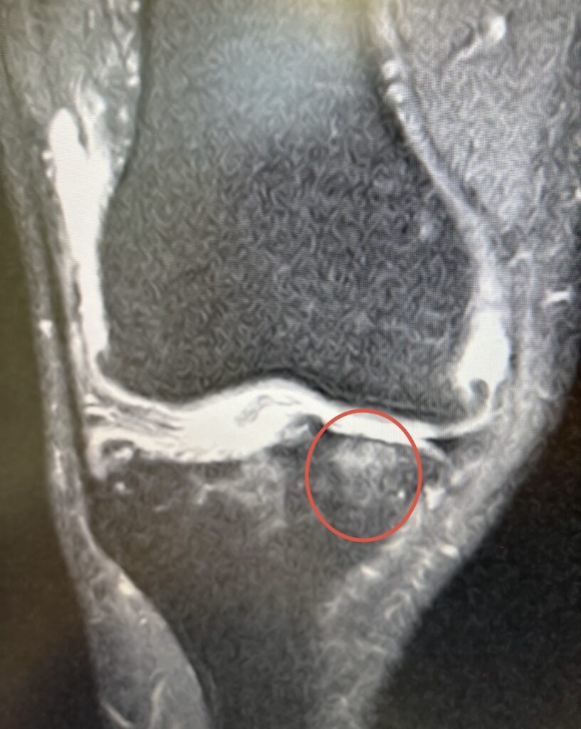 bone marrow lesions knee pain in Miami — Dr. William Bonner Miami