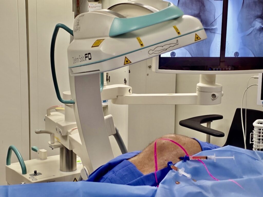 intraosseous stem cell injection knee Miami — Dr. William Bonner Miami