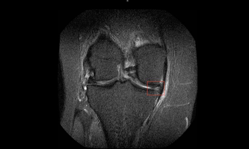 Meniscus tear treatment without surgery Miami — Dr. William Bonner