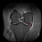 Meniscus tear treatment without surgery Miami — Dr. William Bonner