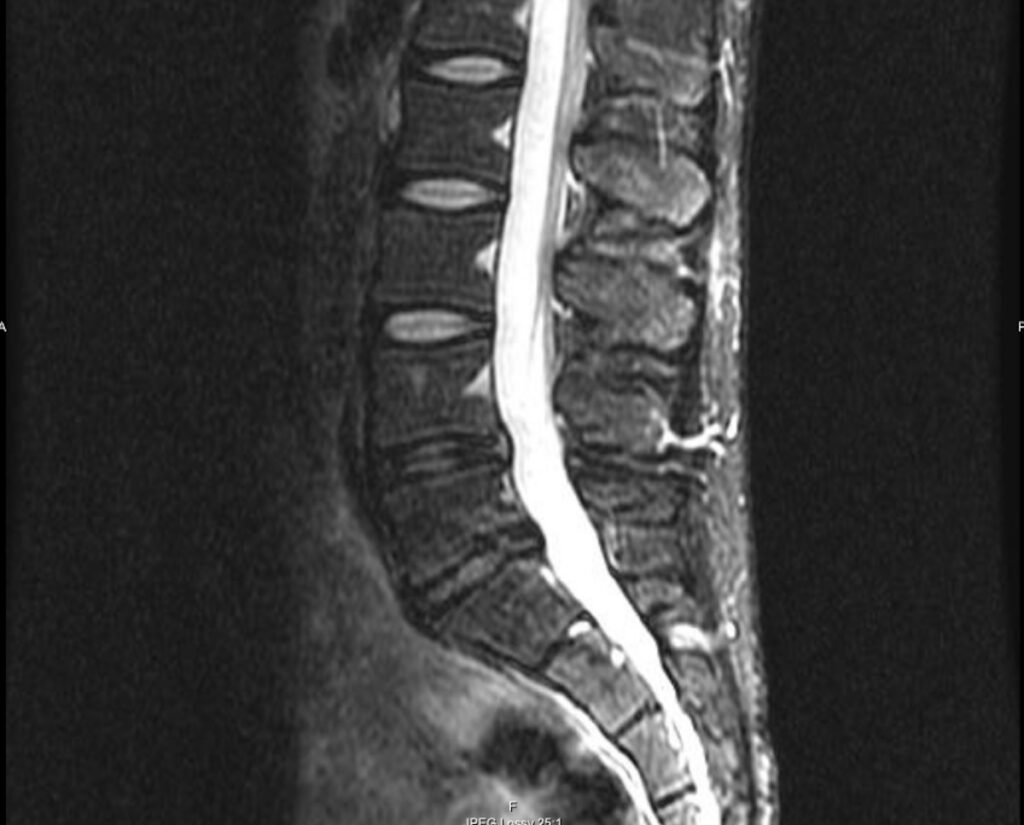 MRI cross-section showing lumbar disc degeneration with disc height loss — treated with regenerative medicine at ProForm MD