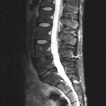 MRI cross-section showing lumbar disc degeneration with disc height loss — treated with regenerative medicine at ProForm MD